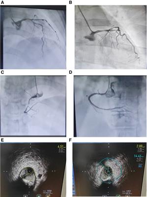 Old woman with Sheehan's syndrome suffered severe hyponatremia following percutaneous coronary intervention: a case report and review of literature